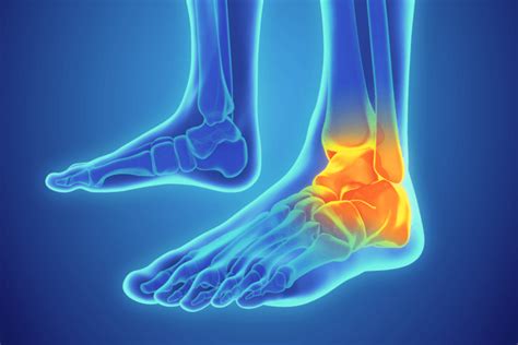 Ankle Sprains Ankle Injuries Symptoms And Treatments