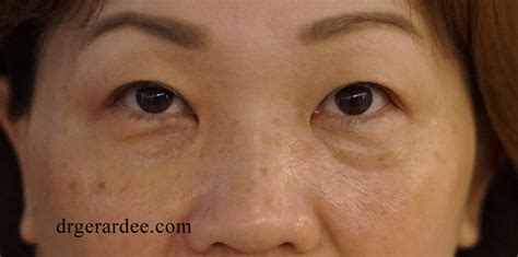 Agnes And Secret Rf The Only Non Surgical Approach To Effectively Remove Eye Bags Dr Gerard Ee