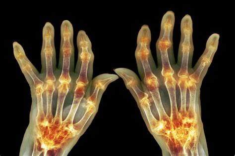 5 Easy Ways To Help You Manage Hand Osteoarthritis Tristate