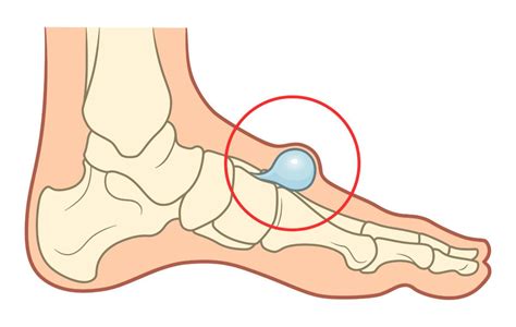 Bump Or Lump On Top Of Foot Causes Symptoms And Best Treatment