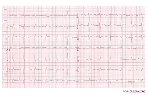 Left Atrial Enlargement Electrocardiogram Wikidoc