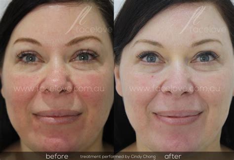 Facial Redness Treatment Before And After Facelove