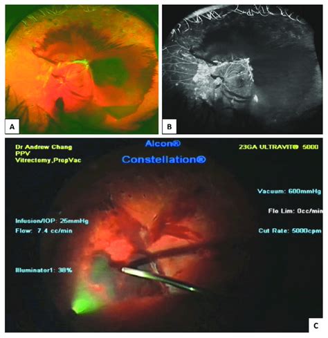 Traction Retinal Detachment And Vitreous Haemorrhage In Proliferative