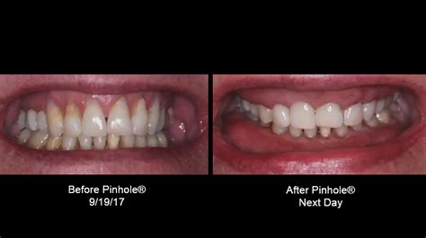 How Effective Is Pinhole Gum Surgery A Pictures Of Hole 2018