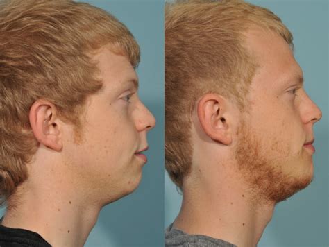 Genioplasty Before And After 1 Jesse E Smith Md Facs Ft Worth