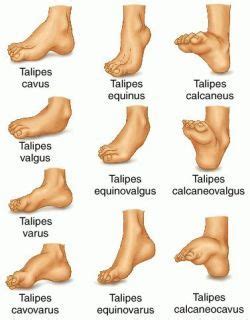 Here we are, panau islands. talipes - definition of talipes in the Medical dictionary ...