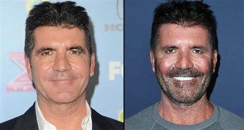 Simon Cowell Plastic Surgery About The Surgery