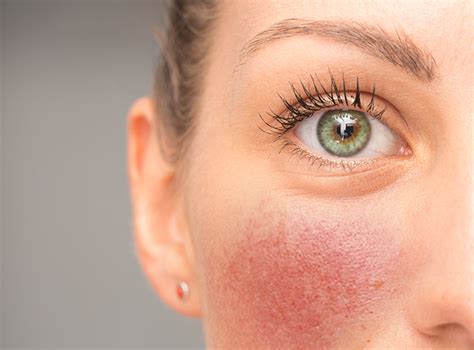 Walk In Dermatology Rosacea Awareness Month Puts Focus On Chronic