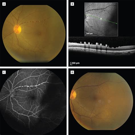 Syphilitic Posterior Uveitis Infectious Diseases Jama Ophthalmology