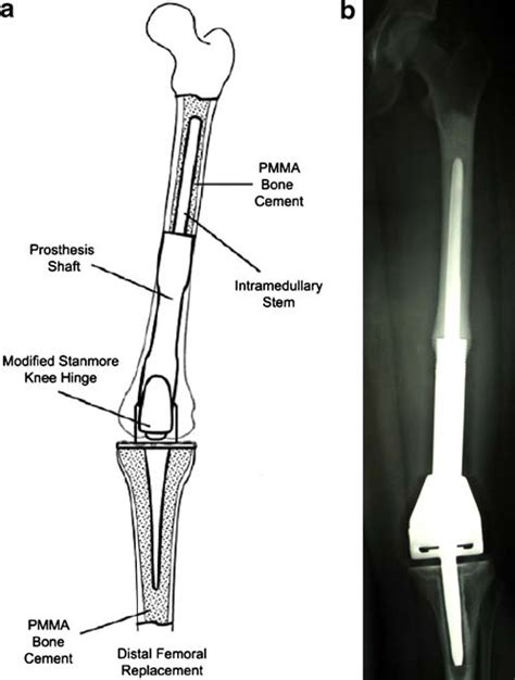 A Schematic Diagram Of Cis Implant Demonstrating Cemented Femoral And