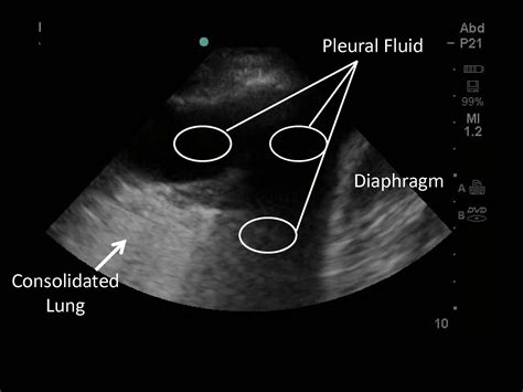 Thoracentesis Pleural Biopsy And Thoracic Ultrasound