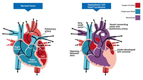 Hypoplastic Left Heart Syndrome — Knowledge Hub