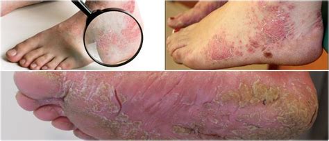 Feet Psoriasis Causes Symptoms Diagnosis And Treatment Hoool