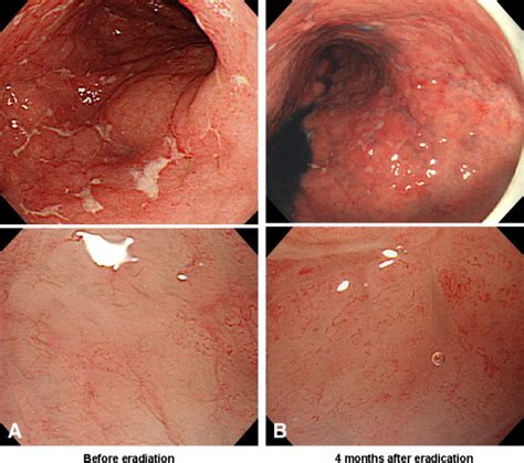 They cannot perform the barrier function. Characteristics of magnified endoscopic images of gastric ...