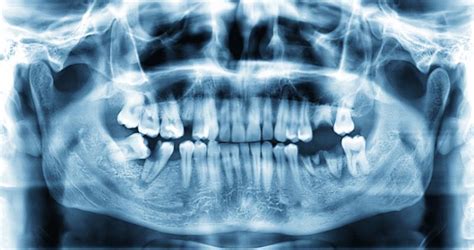 Ząb zatrzymany przyczyny i objawy ES Dentica