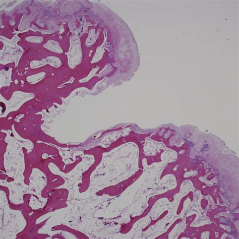 Histology Showing The Regular Bony Trabeculae Covered By The Cartilage