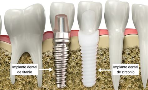 Qu Son Los Implantes Dentales De Zirconio