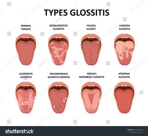 Types Glossitis Tongue Disease Illustration Immagine Vettoriale Stock