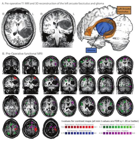 Pre Operative Functional Mri And Diffusion Tensor Imaging Dti In