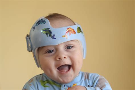What To Know About Positional Plagiocephaly