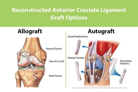 What Type Of Graft Should I Choose For My Acl Reconstruction Surgery
