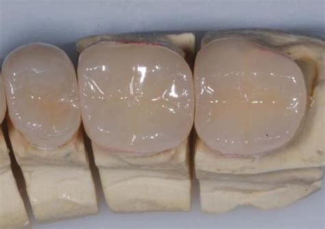 Partial Vs Complete Coverage Restorations Dentistry33