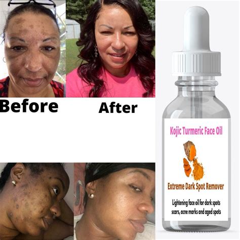 Kojic Turmeric Face Oil Dark Spots Remover Glowing And Etsy Remove