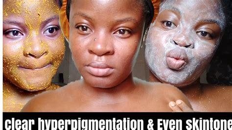 How To Get Rid Of Hyperpigmentation And How To Even Skin Tone Naturally