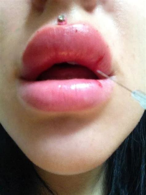 Save Face In The Express Revealed Lip Filler Frenzy Leaving Teenage Girls With Horrific Damage