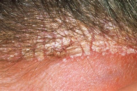 Skin Problems And Treatments Guide To Seborrheic Dermatitis