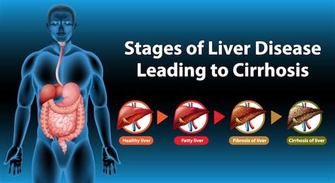 Premium Vector Stages Of Liver Disease Leading To Cirrhosis