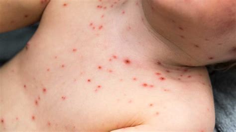 Chickenpox Vs Measles Symptoms Pictures Treatment And More