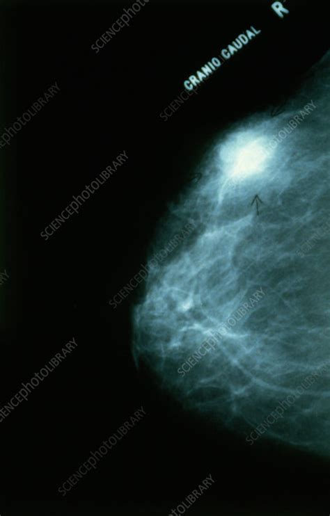 Breast Cancer On Mammogram Stock Image M1220046 Science Photo