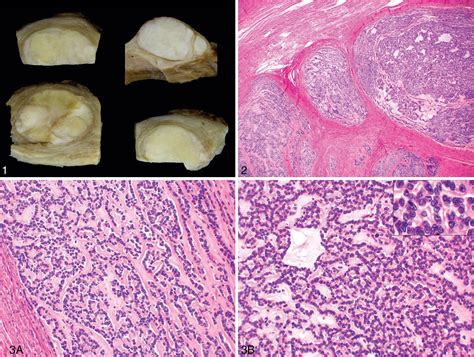 Figure 1 From Uterine Tumors Resembling Ovarian Sex Cord Tumors Semantic Scholar