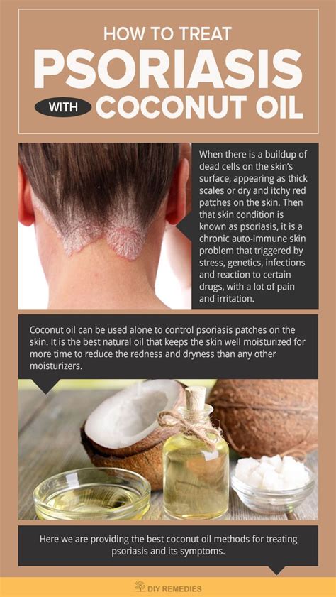 Herbal Remedies For Scalp Psoriasis Home