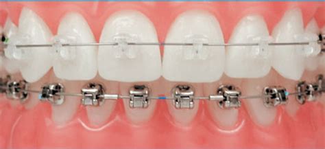 ortodontia corretiva vitacea