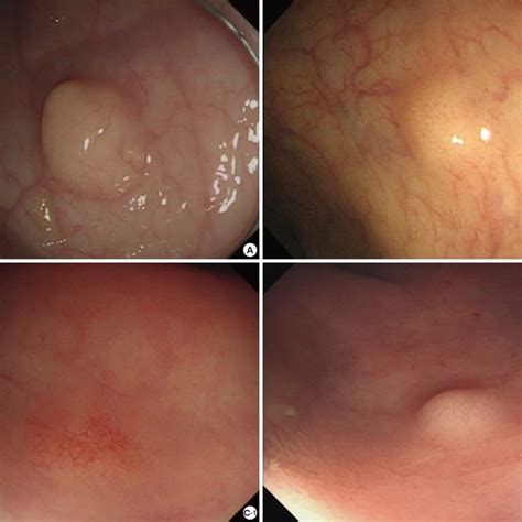 Color And Endoscopic Morphology Of Rectal Carcinoid Tumor Among The 98