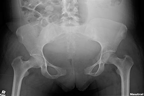 Ap view of normal pelvis. Case Report: Severe Pelvic Pain After Childbirth ...