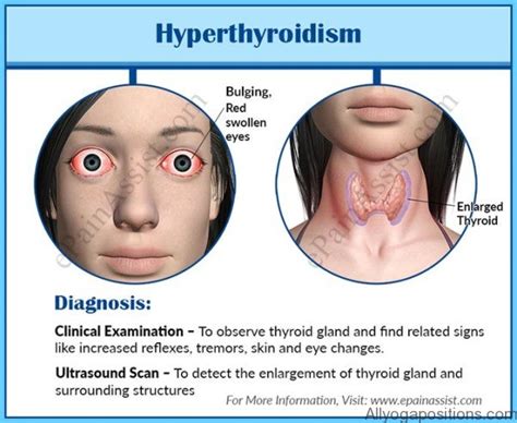 Hypothyroidism Causes Symptoms And Treatments Allyogapositions Com