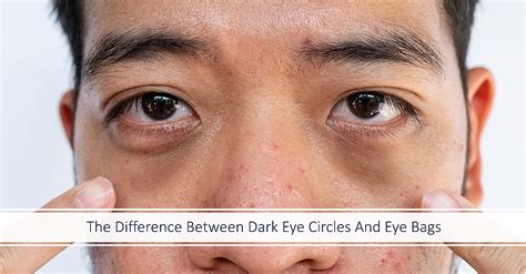 Aggregate More Than Eye Bags Vs Dark Circles Latest In Duhocakina
