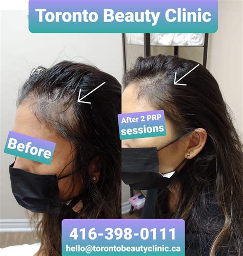 Top 48 image prp in hair treatment