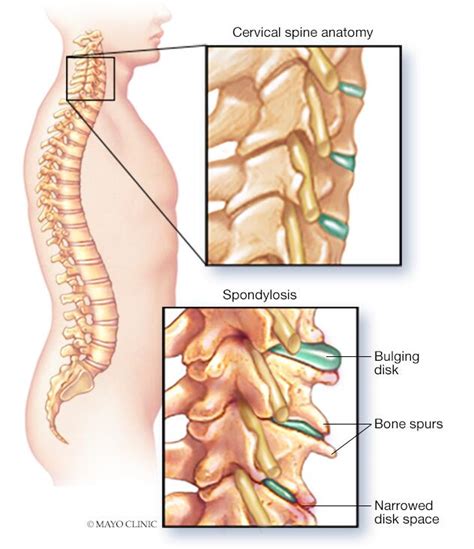 Cervical Spondylosis Symptoms Causes Mayo Clinic