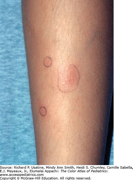 Mononucleosis Rash Amoxicillin Rash In A Patient With Infectious