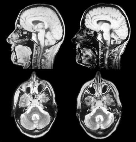 Magnetic Resonance Imaging Of The Brain In Patient 2 In 1996 Left And