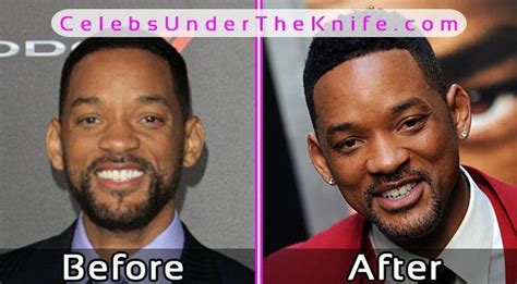 Will Smith Plastic Surgery Photos Before And After With Images