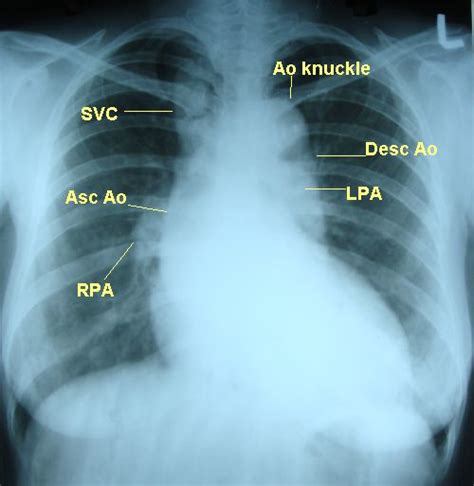 Dilated Aorta With Unfolding Of Arch On X Ray Chest Pa View All About