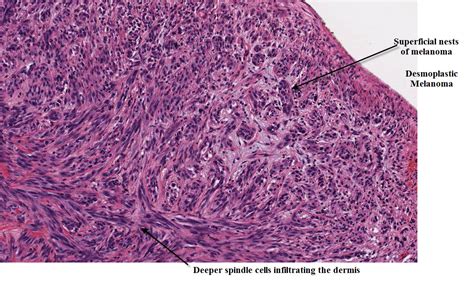 Dermpath Made Simple Neoplastic Desmoplastic Melanoma