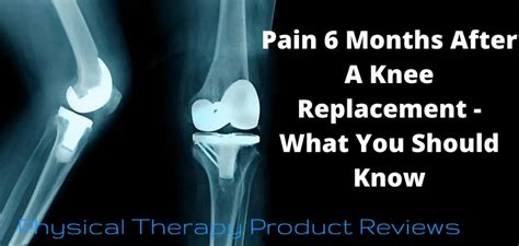 Pain 6 Months After A Knee Replacement What You Should Know Best