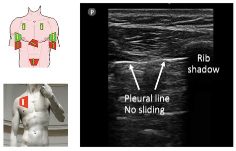 Focused Assessment With Sonography In Trauma Pneumothorax