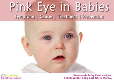 Pink Eye In Babies Symptoms Causes Treatment And Prevention